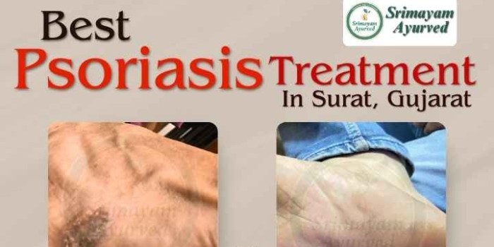 SRIMAYAM AYURVED - Psoriasis treatment in Gujarat